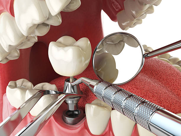 Best Emergency Tooth Extraction in Midway North, TX