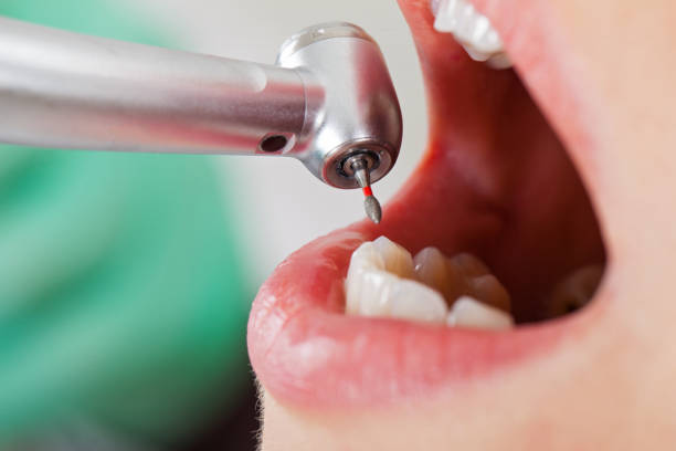 Best Emergency Tooth Extraction in Midway North, TX